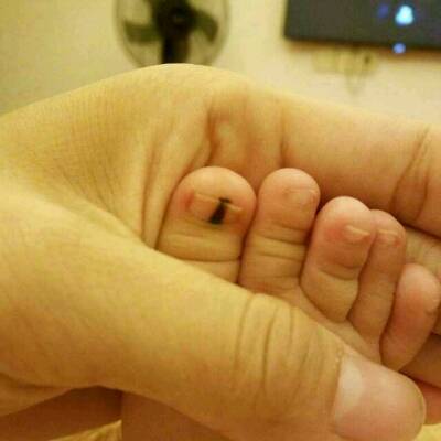 一出生脚趾头的指甲有一条黑线,现在四个多月了,上网查了下说是甲母痣