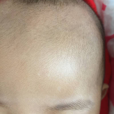 宝宝四个月了,后脑勺和前额眉间都有白点