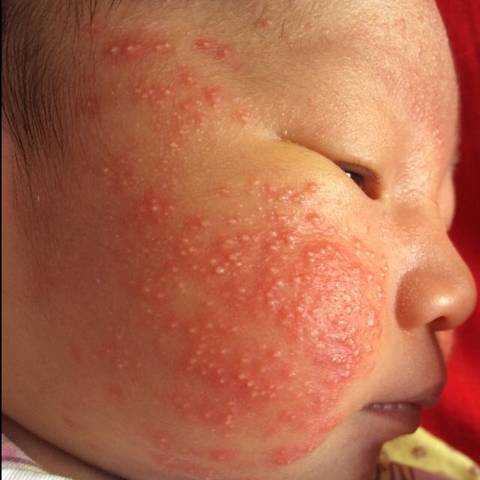 湿疹和新生儿痤疮的区别