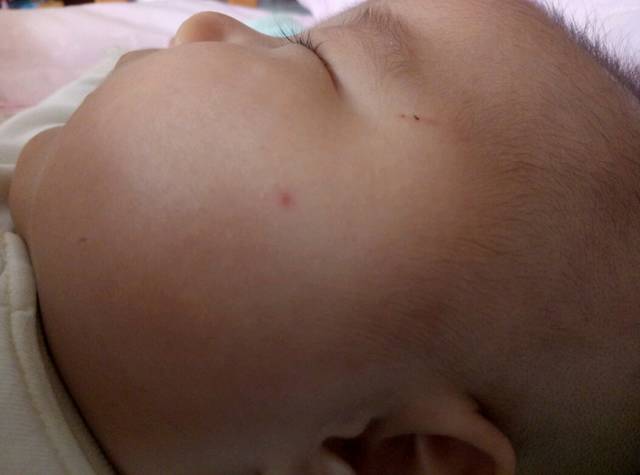 宝妈们好_麻烦看看三个月宝宝脸上的红点点是
