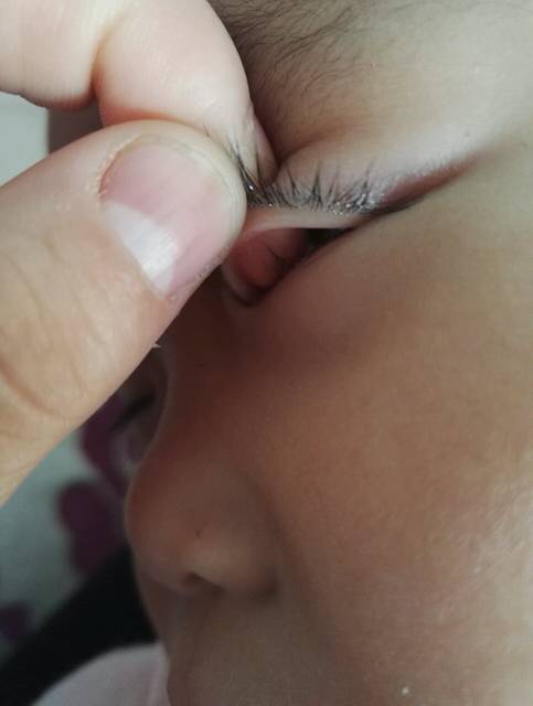 我家宝宝1周9个月了,眼皮里长了一个小红疙瘩