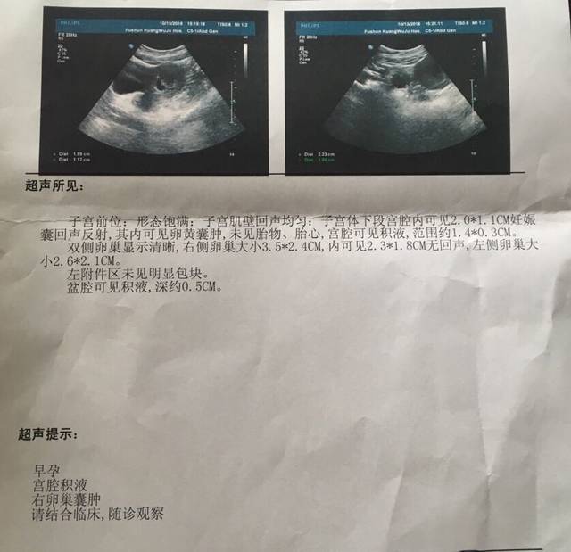 怀孕一个月,因为走血到医院做了彩超医生说胎