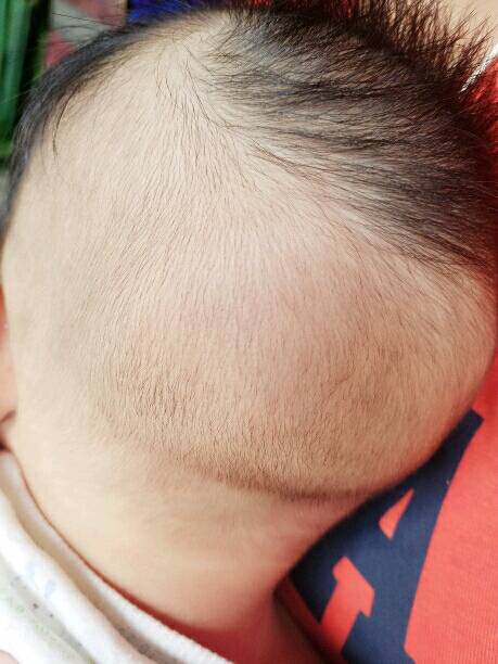 宝宝后脑勺没头发_我家宝宝都三个月了 后脑勺