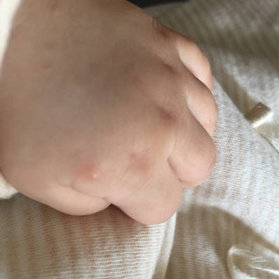 宝宝手上有几个小水泡,刚开始是红点好像是蚊