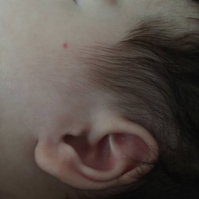亲们帮看看脸上的红斑_宝宝一个月的时候被蚊