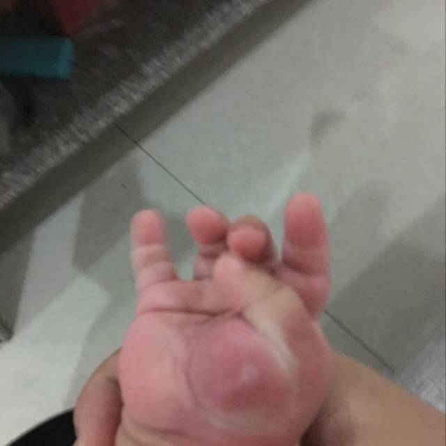 急宝宝的手不知道被什么东西咬了红肿然后有一
