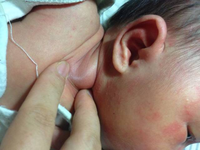 求助 脸上红点 脖子硬块_我的宝宝22天 脸上和