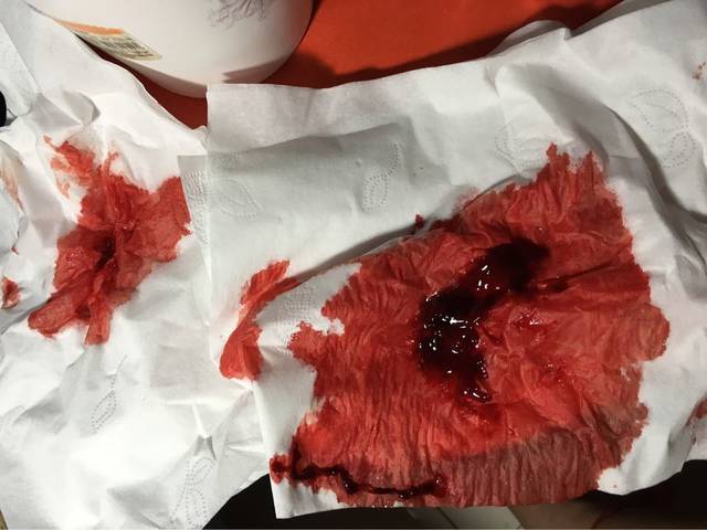 有没有宝妈半夜口腔大出血跟吐血似的?_图片可能引起不适,宝妈_宝宝树
