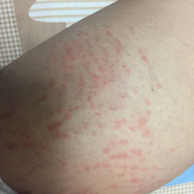 小儿痒疹一般要长多久_长湿疹是身体排毒表现