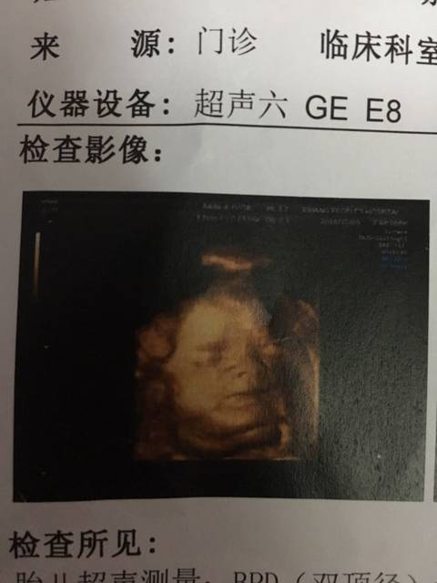 胎儿颈部淋巴管瘤_现在怀孕24周了,检查出来胎