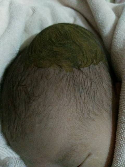 交心_有宝妈的宝宝头上有个软包的吗 医生都说