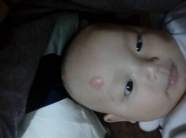 求助,求助,宝宝头上起包!_求助,四个多月宝宝头