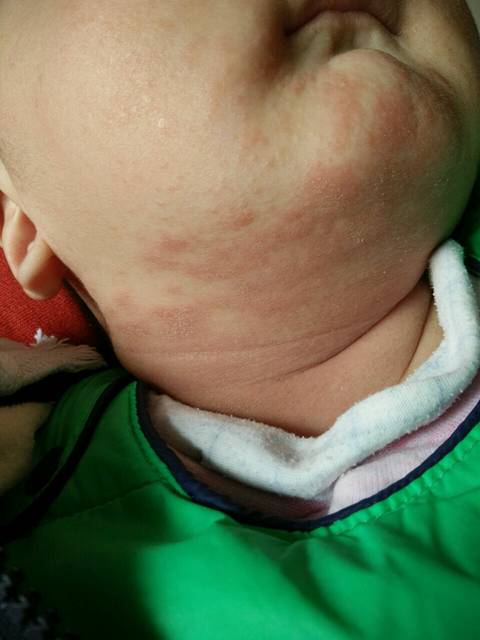 宝宝六个多月脖子上起红疙瘩_宝宝脖子上起红