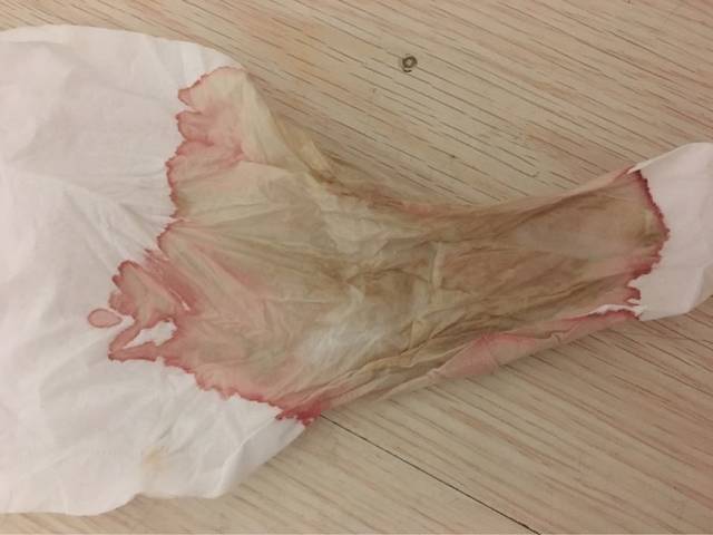 担心!孕初期流褐色分泌物带血,有图慎入!