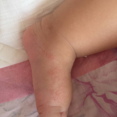 宝宝七个多月了,脚上一直有这些红点,是怎麼回事啊?