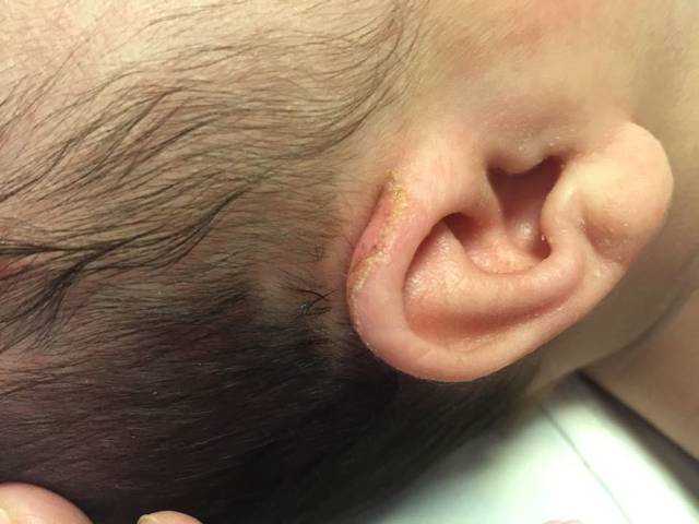 耳朵这是怎么了_以前长过湿疹 可现在老是淌脓
