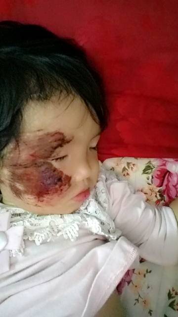 我女儿前两天被小车撞倒擦伤脸要怎样才不会留