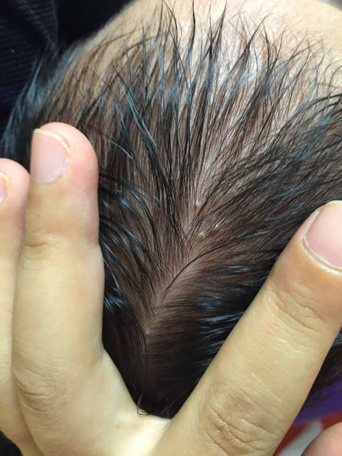 新生儿看图:脸上是湿疹吗、还有头发里_头发里