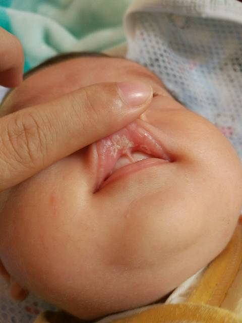 宝宝嘴巴长白泡;急死了_去看了中医说是肚子胀