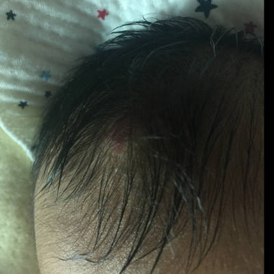 我家宝宝头顶一块红斑好像还凸出一个疙瘩,请