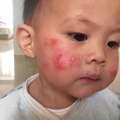 宝宝快两岁了,最近脸上湿疹特别严重,都出血了