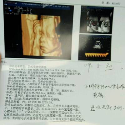 昨天去做了下四维,发现孩子心脏有个点,医生让