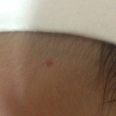 宝宝刚满月,最近发现额头发际线处有这个,像毛