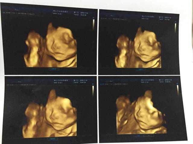 四维B超.心脏彩超和无创通过,开心开心