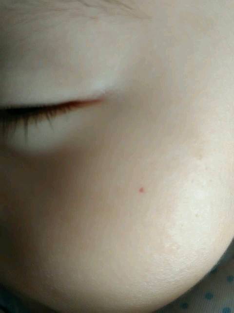 100天宝宝脸上一个皮下小红点_100天宝宝脸上