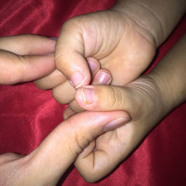 求助!两岁宝宝指甲盖变少手指脱皮_宝宝从几个