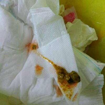 四个月的宝宝大便又血怎么回事?之前跟手足口
