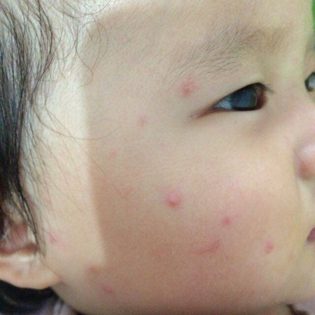 孩子脸上湿疹2月都没好_宝宝脸上湿疹到2个月