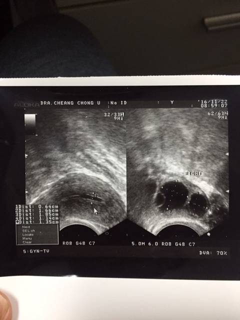 宫腔分离,会影响怀孕吗?有宫腔分离又怀上的分