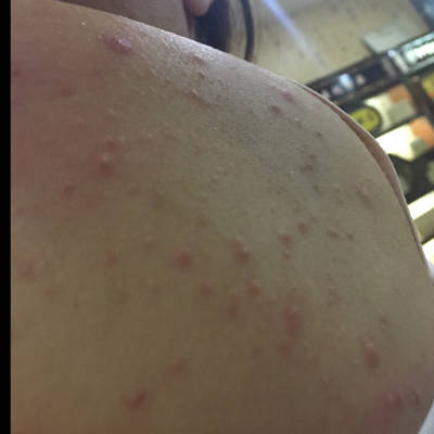 怀孕31周,有没有宝妈跟我一样全身长痘的,背上