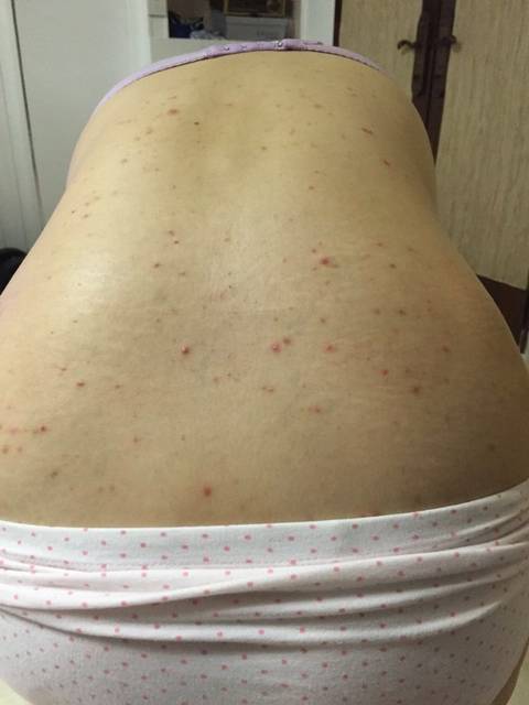 背部好痒,长了很多红点,像痘痘那样_背部好痒