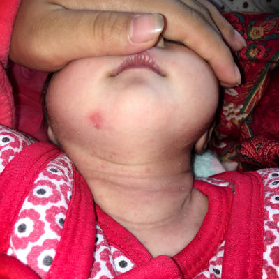 宝贝脖子上有好多小红点,身上也有,是湿疹吗