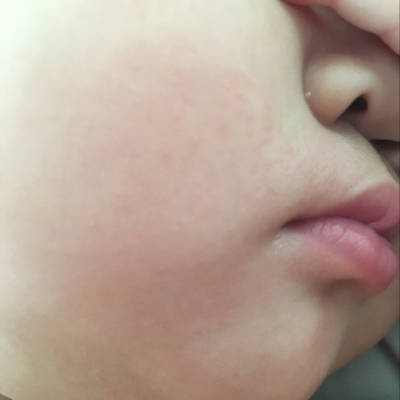 岁宝宝嘴周围和脖子上长了好多小米粒大小的痘