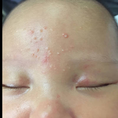 宝宝两个月,纯母乳,脸上突然冒出这样的带白头