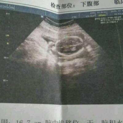 . 头围:16.7cm. 腹围:14.7cm. 股骨:2.7cm. 胎盘: