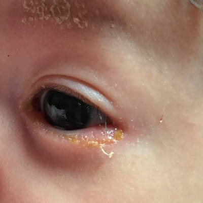 一个月多的婴儿下眼皮发炎一样是什麼原因.最开始只是