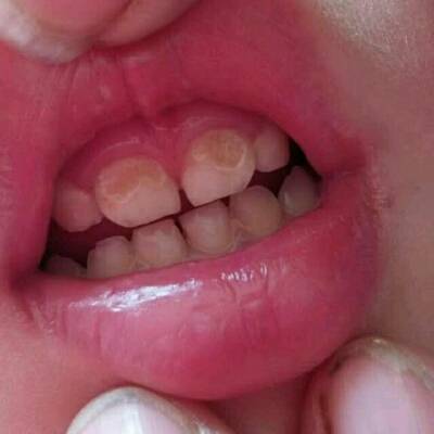 请问两岁半小孩前面两颗牙齿像坏了一样是怎么