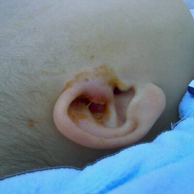 宝宝耳前瘘管发炎,已经流脓出来了,很久了,还是