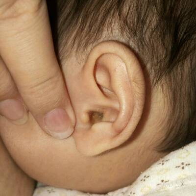 有谁知道宝宝耳朵里流出来的是什么吗?黄黄的