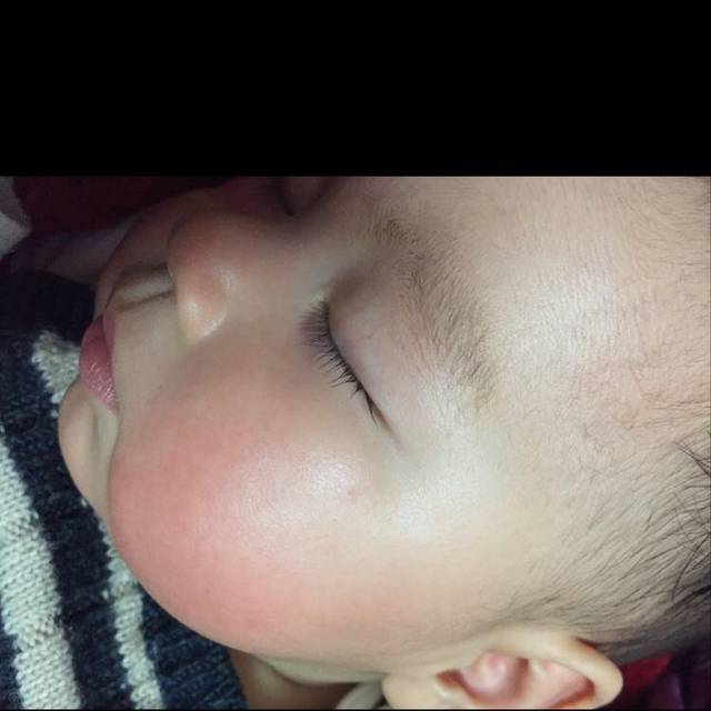 宝宝被毒蚊子咬了两个月了,脸上的印记还没有