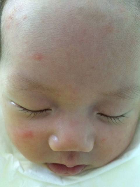 新生儿25天脸上长了好多红点,是湿疹吗?_有宝