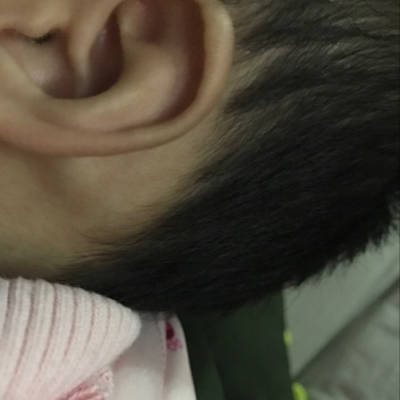 八个多月宝宝今天突然发现耳朵后面长了个包这