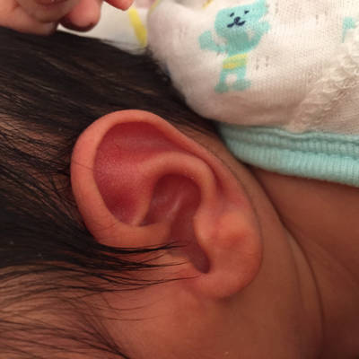宝宝出生12天,耳朵旁边有个小疙瘩,但还没有突