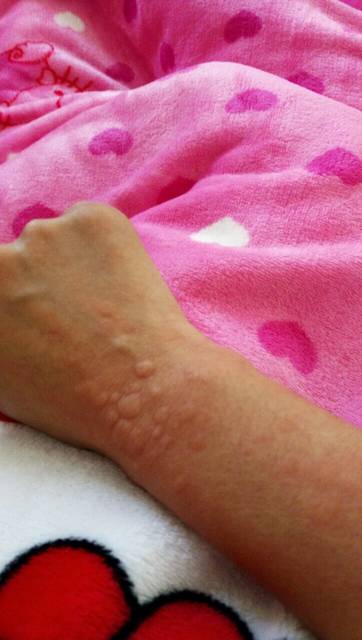 得了荨麻疹怎么办?_孕8周得了荨麻疹,痒死了,