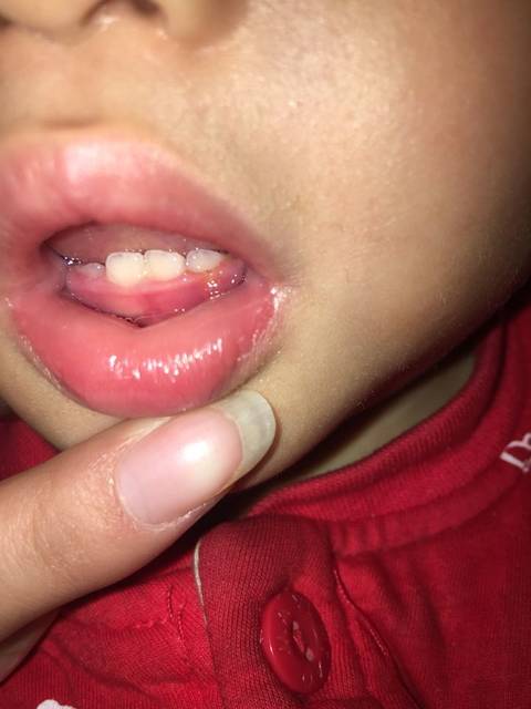 牙齿_宝宝13个月牙齿底部牙龈处发黄疼痛怎么