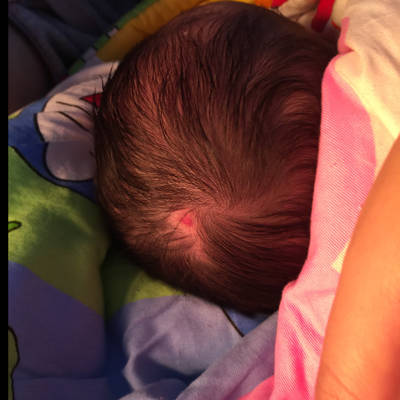 宝宝出生时头皮被弄破了,后来结疤又掉了 现在